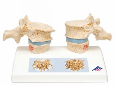 3B-Scientific® Osteoporose Modell