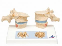3B-Scientific® Osteoporose Modell